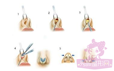 上海九院假体隆鼻需要多少钱