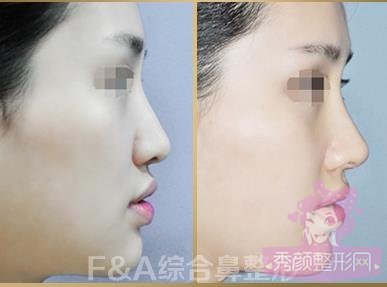 上海喜美王会勇医生隆鼻怎么样?怎么预约?
