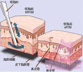 抽脂减肥价格一览表