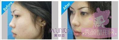 上海美联臣李耐国隆鼻怎么样?多少钱?