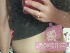 做了腰腹吸脂,来感受下我的小蛮腰~