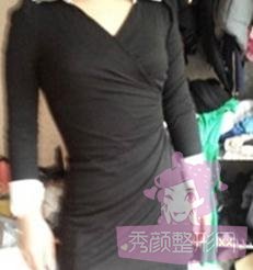 做了腰腹吸脂,来感受下我的小蛮腰~
