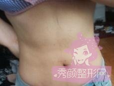 做了腰腹吸脂,来感受下我的小蛮腰~