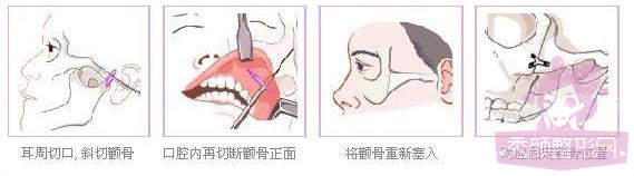 北医三院王侠做磨骨手术怎么样？价格是多少？