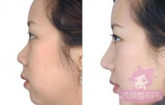<b>上海九院王涛隆鼻怎么样？价格是多少？</b>