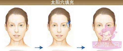 西安西京医院做自体脂肪丰太阳穴好不好?