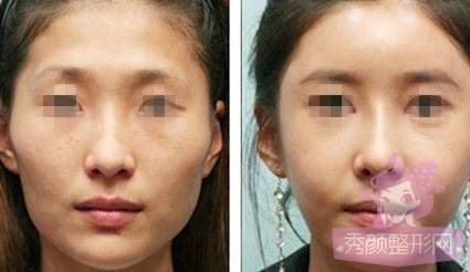 西安西京医院做自体脂肪丰太阳穴好不好?