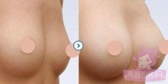 <b>自体脂肪隆胸大概需要多少钱？</b>