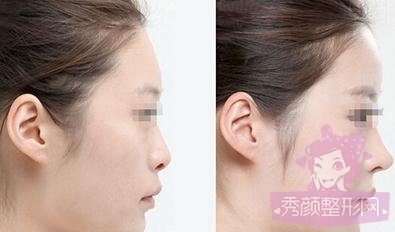 上海九院戴传昌隆鼻怎么样?有失败案例吗?