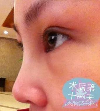 分享双眼皮和隆鼻日记,过程有点小恐怖