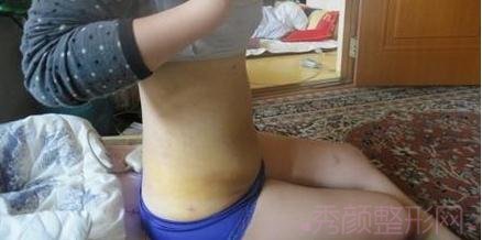 腰腹吸脂术后一周后记,看看瘦了吧