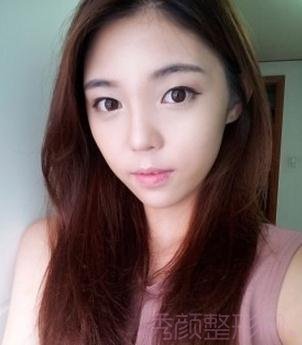 做了隆鼻和磨骨,怎么样,韩国范儿~