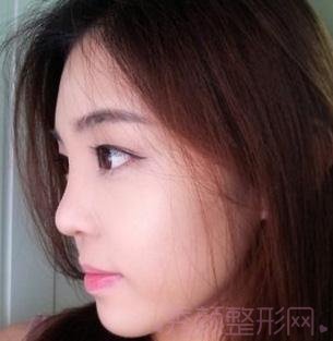 做了隆鼻和磨骨,怎么样,韩国范儿~