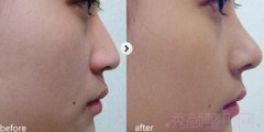 <b>上海百达丽沈国雄隆鼻怎么样？多少钱？</b>