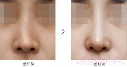 上海九院王涛做鼻部手术怎么样?有失败案例吗?