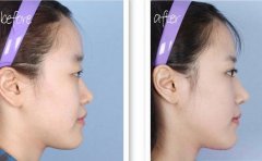 武汉美基元隆鼻怎么样？多少钱？