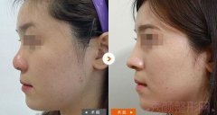 上海九院隆鼻多少钱？