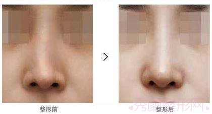 北京鼻部手术整形手术需要多少钱？哪个医院好？