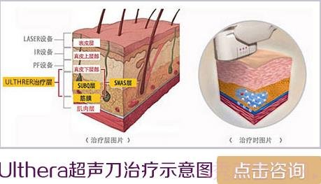 北京哪家医院超声提拉好?多少钱?