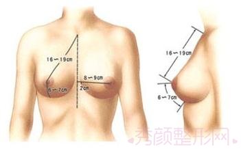 西安西京整形医院自体脂肪隆胸怎么样？多少钱