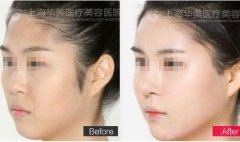 <b>上海华美李健做全脸自体脂肪填充怎么样？</b>
