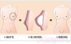 <b>北京隆胸哪个医生好？多少钱？</b>