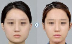 <b>上海九院余东做磨骨术怎么样？多少钱？</b>