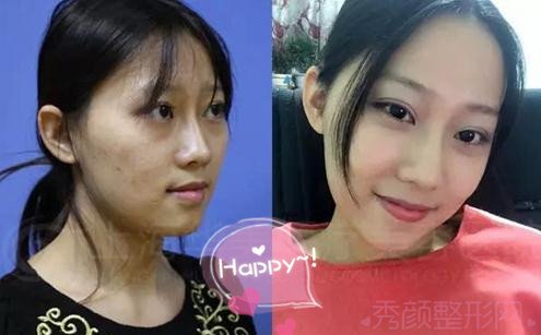 上海华美李志海博士做的颧骨内推,怎么样?