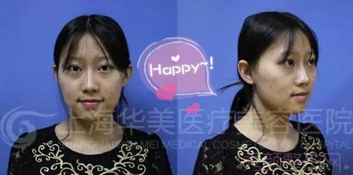 上海华美李志海博士做的颧骨内推,怎么样?