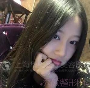 上海华美李志海博士做的颧骨内推，怎么样？