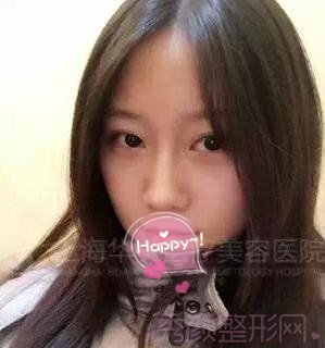 上海华美李志海博士做的颧骨内推,怎么样?