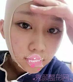 上海华美李志海博士做的颧骨内推,怎么样?