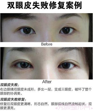 北京韩勋修复双眼皮怎么样？双眼皮失败修复案例。