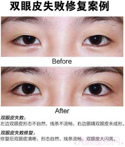 北京韩勋修复双眼皮怎么样？双眼皮失败修复案例。