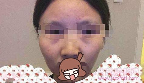 成都素美自体脂肪填充面部术前术后分享