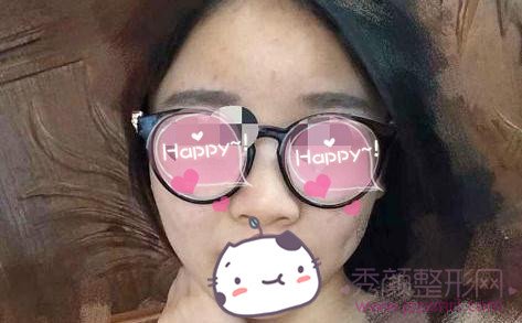 成都素美自体脂肪填充面部术前术后分享