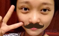 华美杨亚益做的8mm双眼皮,觉得6-7mm的较好