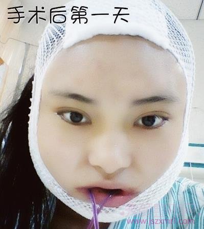 做了下颌角磨骨整形手术，脸真的小多了