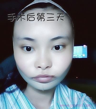 做了下颌角磨骨整形手术，脸真的小多了