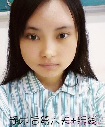 做了下颌角磨骨整形手术，脸真的小多了