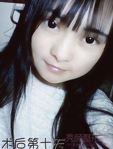 做了下颌角磨骨整形手术，脸真的小多了