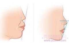 <b>详细介绍突（凸）嘴手术以及突嘴矫正三种方式</b>
