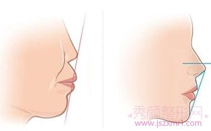 详细介绍突（凸）嘴手术以及突嘴矫正三种方式