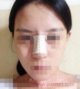 我的隆鼻真实案例分享，过程有点疼但是满意