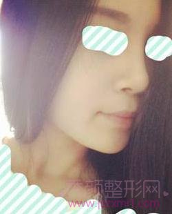 我的隆鼻真实案例分享,过程有点疼但是满意