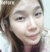 上海华美许再荣割的双眼皮，大眼不再是梦