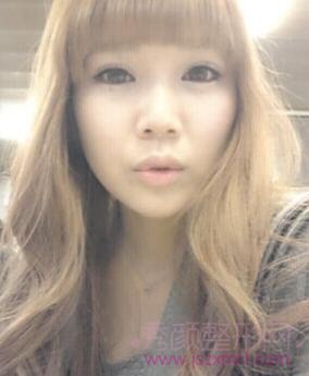 上海华美许再荣割的双眼皮,大眼不再是梦