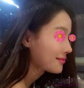 <b>上海喜美王会勇隆鼻案例</b>
