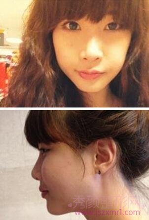 我终于做了歪下巴矫正手术，喜极而泣