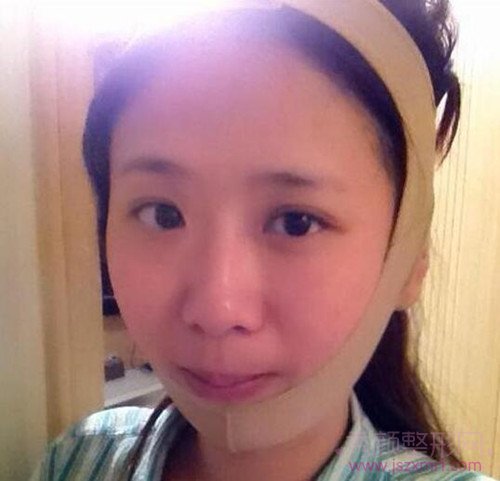 【案例分享】华美李志海下颌角整形和垫下巴